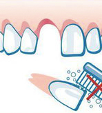 Notfall Zahn ausgeschlagen
